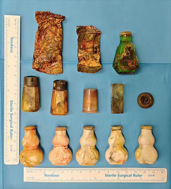 objets retrouvés dans un vagin